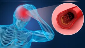 Campanha de Conscientização Sobre o AVC: Brasil Registra Quase 40 Mil Mortes em 2024